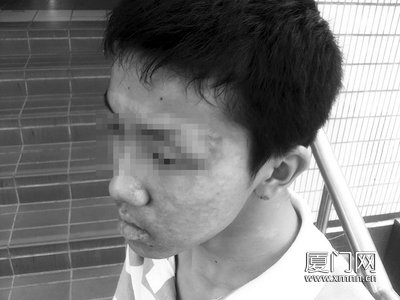 17岁少年打工被烧伤脸 餐厅赔付九千元整容