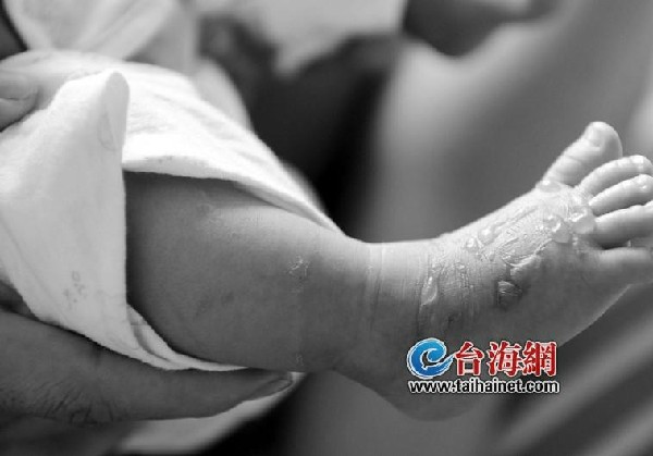 男婴打完点滴脚背长水疱 院方:或是漏液,过敏引起