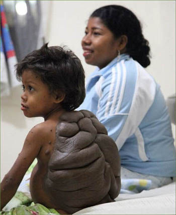南美洲哥伦比亚一6岁小男孩身患极为罕见的巨型先天性黑色素细胞痣,周