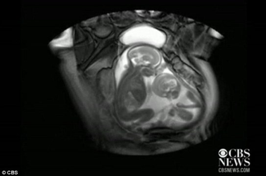 扫描发现双胞胎在子宫里“掐架”令人称奇（图）