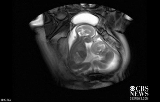 扫描发现双胞胎在子宫里“掐架”令人称奇（图）（2）