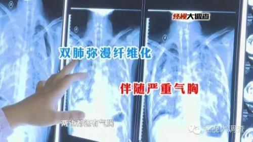 衡阳22岁小伙切割大理石三年 患尘肺身亡1